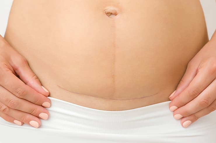 C-Section Rehab treatment